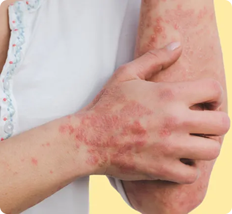 Persona con dermatitis o irritación en la piel del brazo